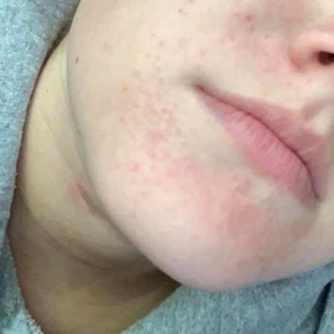 my journey with perioral dermatitis