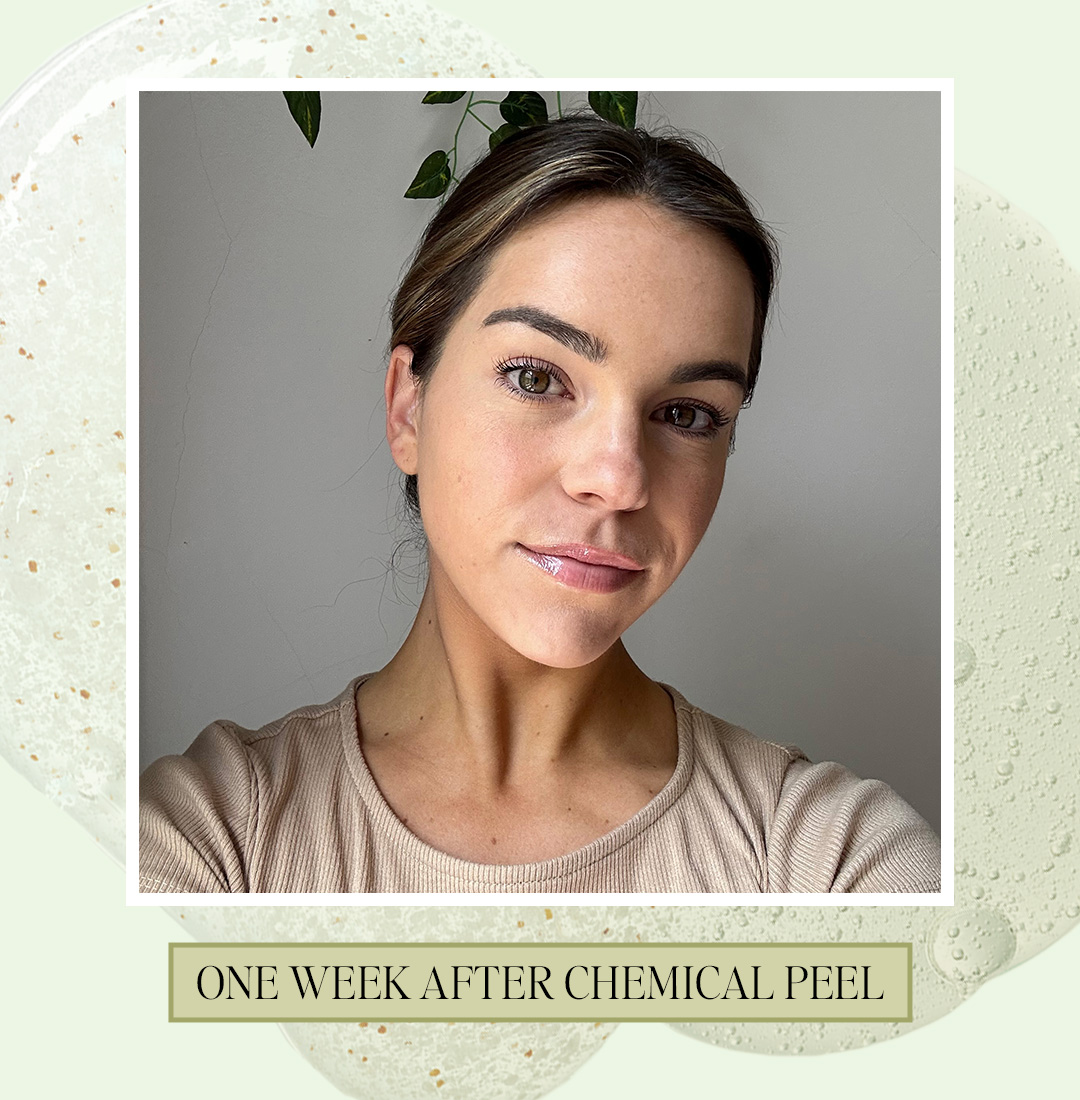 How Chemical Peels Transform My Skin The Everygirl pic