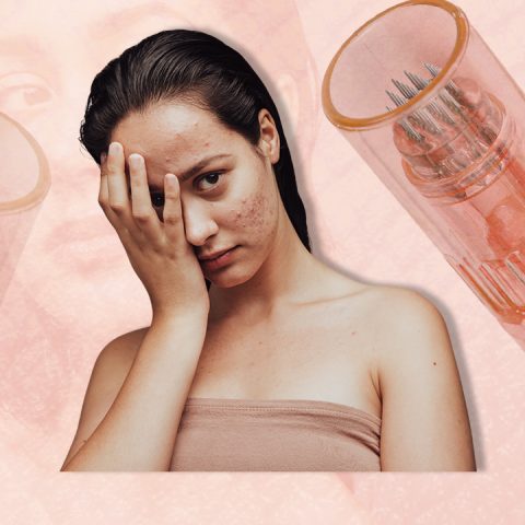 microneedling