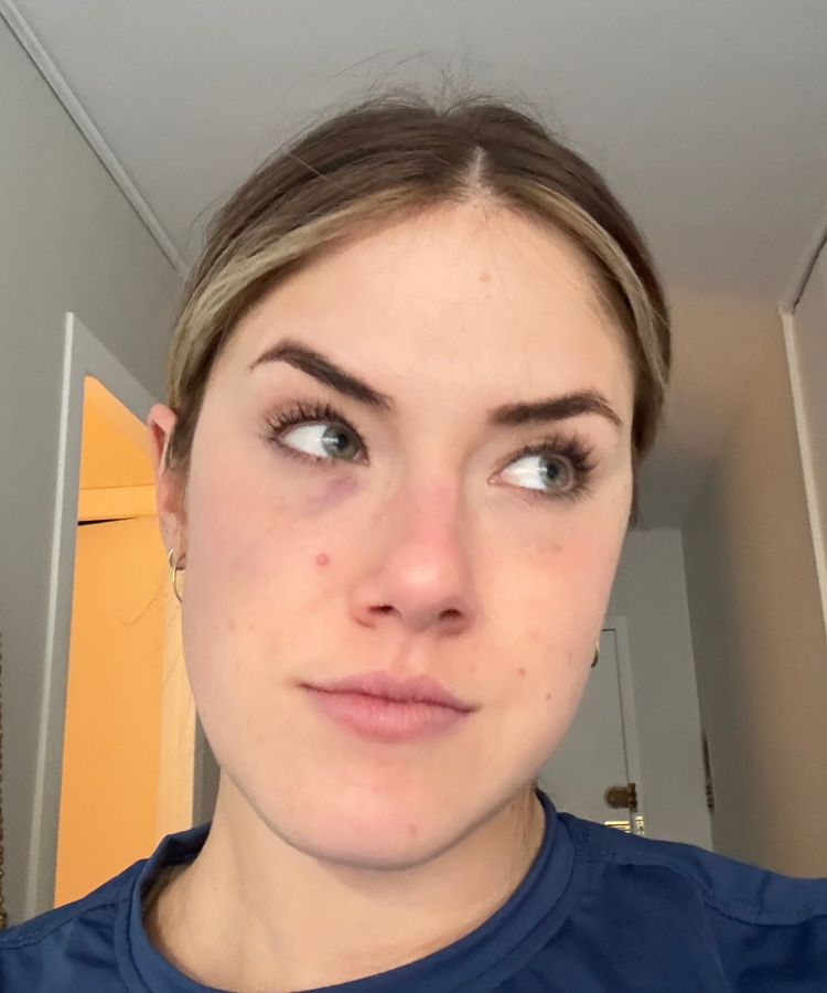 under-eye PRP